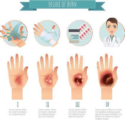減輕 皮膚 燒傷 程度 之 最 重要 步驟 為何